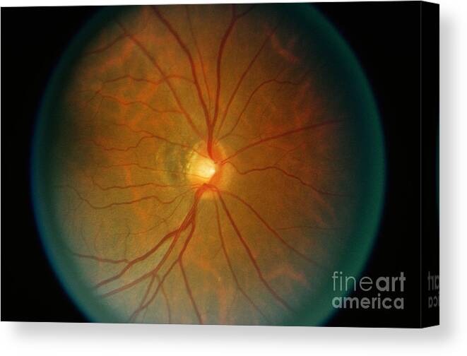 Blood Vessels Canvas Print featuring the photograph Retina, Lupus Patient by Science Source