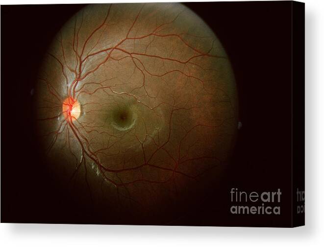 Blood Vessels Canvas Print featuring the photograph Retinal Coloboma by Science Source