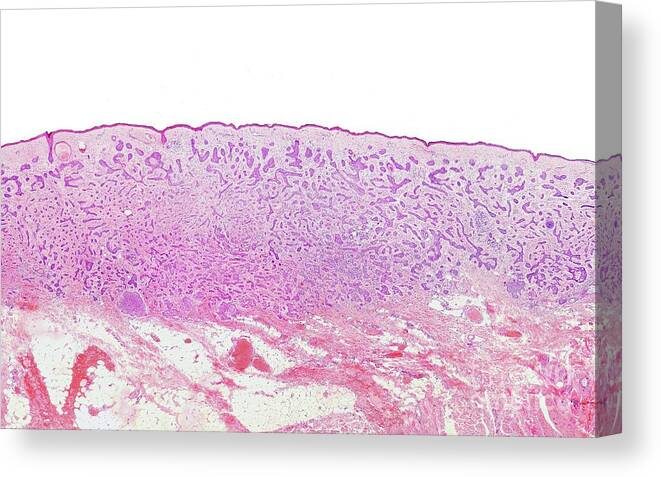 Microscopy Canvas Print featuring the photograph Basal Cell Carcinoma #6 by Jose Calvo/science Photo Library