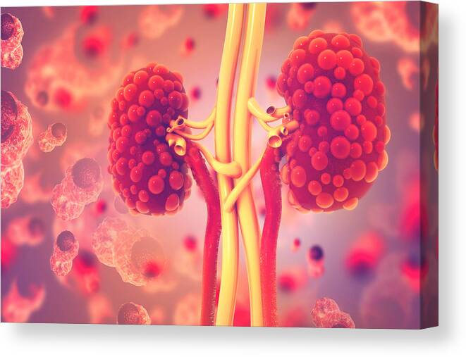 People Canvas Print featuring the photograph Kidney disease by Mohammed Haneefa Nizamudeen