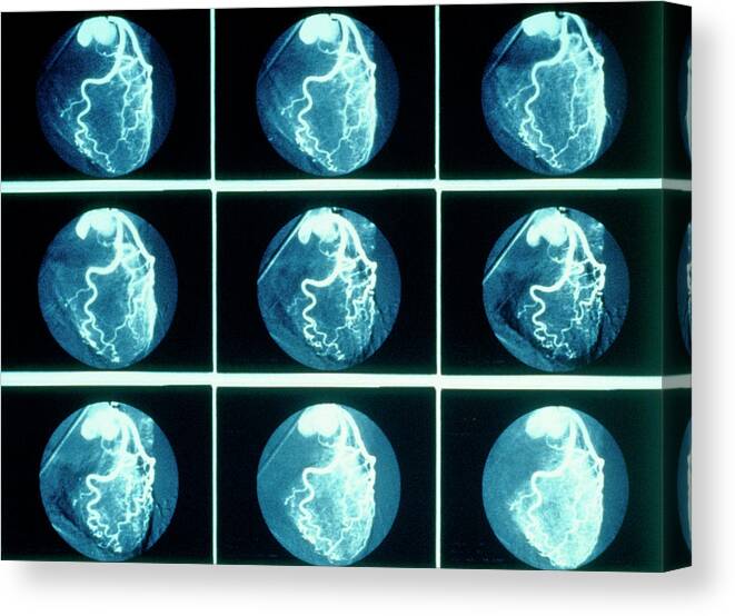 Anatomy Canvas Print featuring the photograph Digital Subtraction Angiography by Alexander Tsiaras