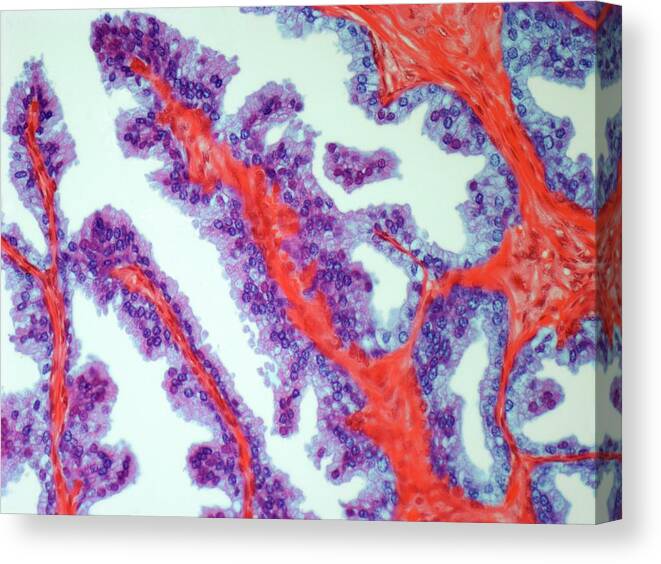 Anatomy Canvas Print featuring the digital art Prostate Cancer, Light Micrograph by Steve Gschmeissner