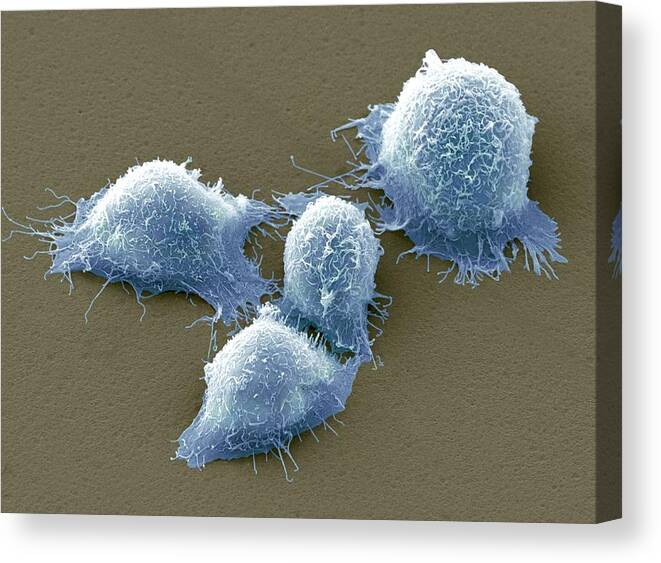 Cervical Cancer Canvas Print featuring the photograph Cervical Cancer Cells, Sem by Steve Gschmeissner