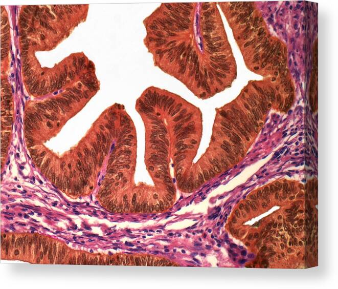 Horizontal Canvas Print featuring the digital art Uterine Cancer, Light Micrograph by Steve Gschmeissner