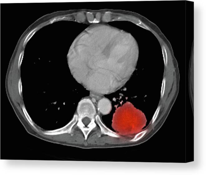 Black Background Canvas Print featuring the digital art Image From A Co-registered Pet-ct Study From Dual Modality Scanner. Patient With Multiple Metastatic Lesions In Liver & Lung. Pet Data Superimposed Over Ct Scan Axial Slice Through Lung Metastases #1 by Callista Images