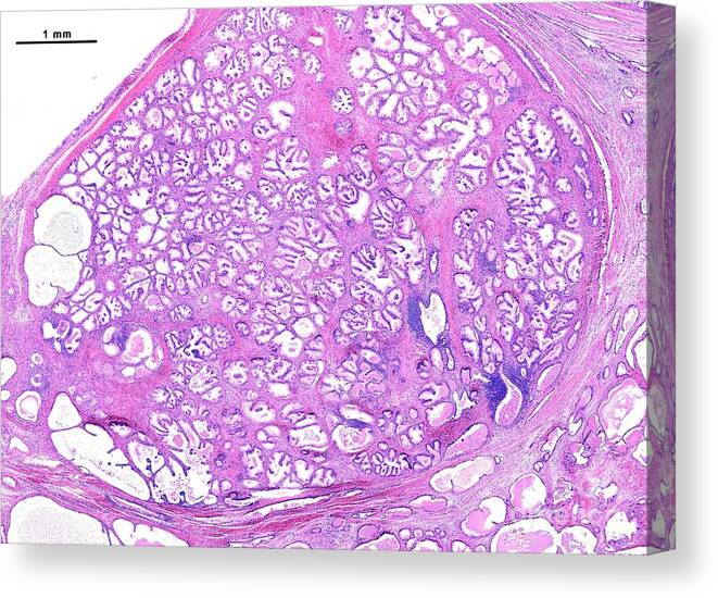 Microscopy Canvas Print featuring the photograph Benign Prostatic Hyperplasia #5 by Jose Calvo/science Photo Library