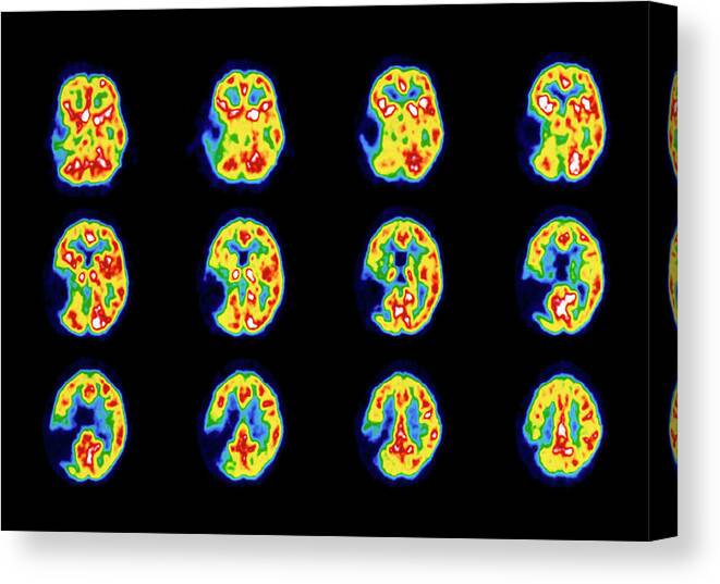 Pet Scan Canvas Print featuring the photograph Colour Pet Scans Of The Brain Of A Stroke Patient by Wellcome Dept. Of Cognitive Neurology/ Science Photo Library