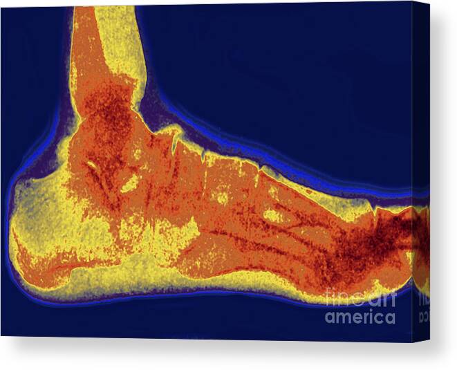 X-ray Canvas Print featuring the photograph Flat Foot X-Ray by Bsip