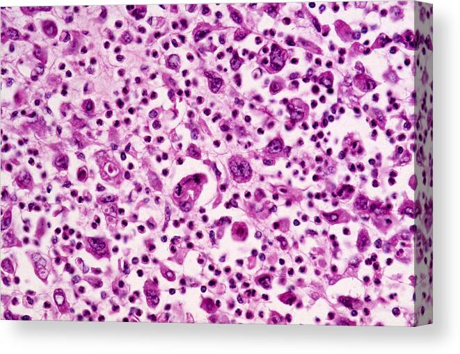 Abnormal Canvas Print featuring the photograph Giant-cell Carcinoma Of The Lung, Lm by Michael Abbey