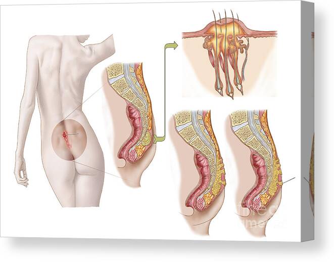 Horizontal Canvas Print featuring the digital art Medical Ilustration Of A Pilonidal Cyst by Stocktrek Images