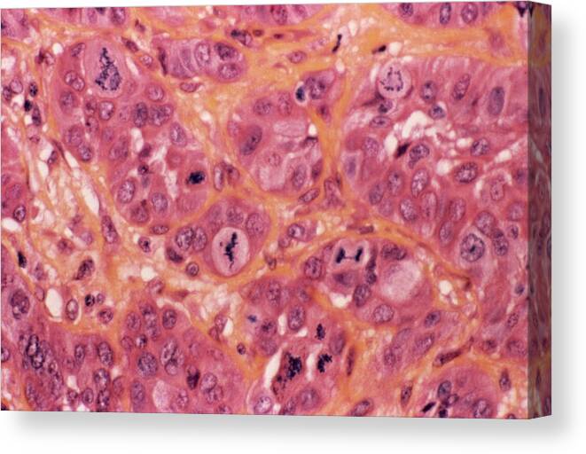 Adenocarcinoma Canvas Print featuring the photograph Stomach Cancer by Cnri/science Photo Library