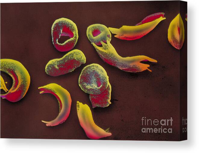 Drepanocytes Canvas Print featuring the photograph Sickle-cell Anemia, Sem #3 by Omikron