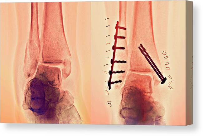 Break Canvas Print featuring the photograph Pinned Ankle Fractures #1 by Zephyr/science Photo Library