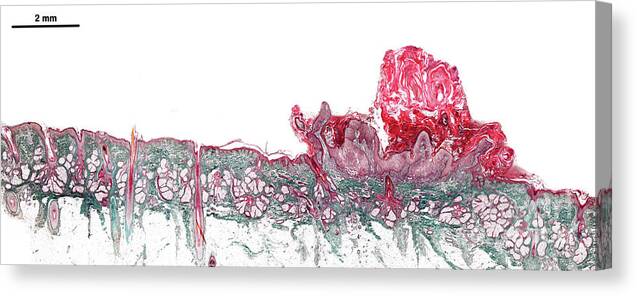 Microscopy Canvas Print featuring the photograph Human Scalp Wart by Jose Calvo/science Photo Library