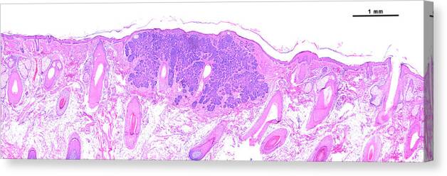 Microscopy Canvas Print featuring the photograph Basal Cell Carcinoma #3 by Jose Calvo/science Photo Library