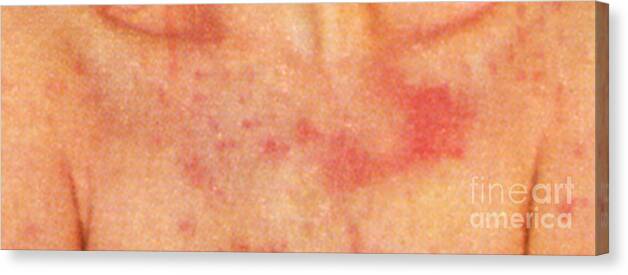 Psoriasis Chest Canvas Print featuring the photograph Acute Psoriasis by Science Source