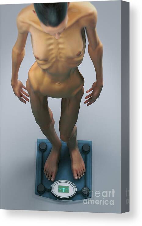 Ekg Canvas Print featuring the photograph Anorexia by Science Picture Co