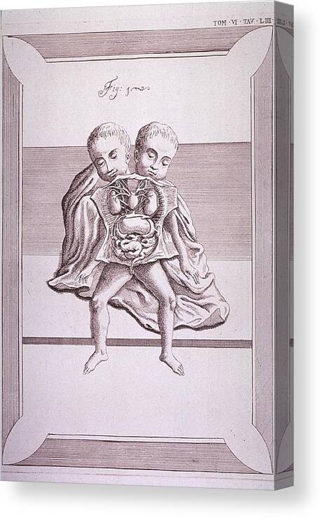 History Canvas Print featuring the photograph Conjoined Twins With Common Torso by Everett