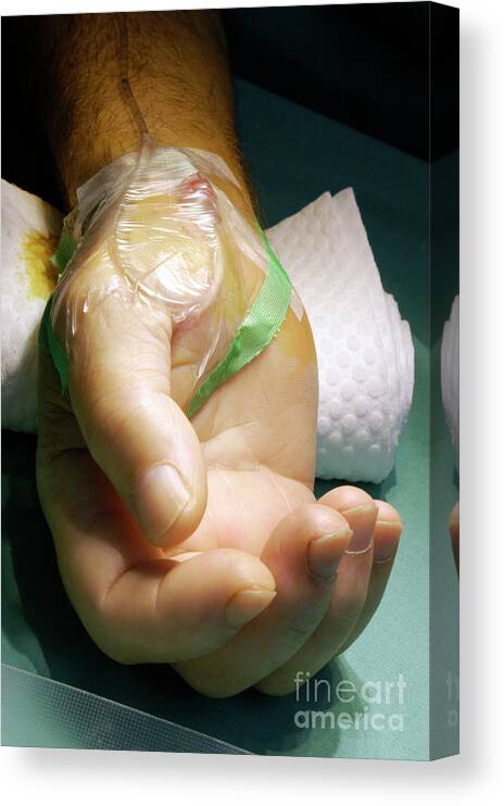 Line Canvas Print featuring the photograph Anaesthesia #1 by Aj Photo/science Photo Library