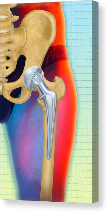 Art Canvas Print featuring the photograph Prosthetic Hip Replacement by Chris Bjornberg
