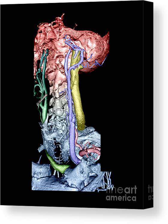 Medical Canvas Print featuring the photograph Color Enhanced 3d Cta Of Neck #1 by Living Art Enterprises, LLC