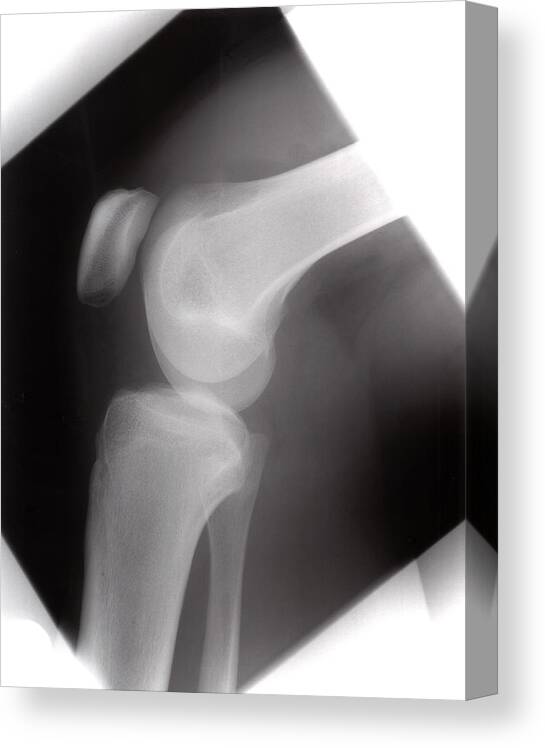 Xray Canvas Print featuring the photograph Healthy Knee #1 by Daniel Sambraus/science Photo Library