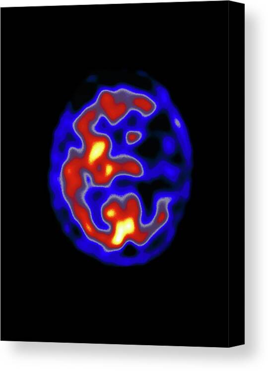 Pet Scan Canvas Print featuring the photograph Coloured Pet Scan Of The Brain Of A Stroke Patient #2 by Dept. Of Nuclear Medicine, Charing Cross Hospital/science Photo Library