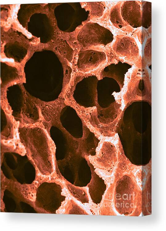 Science Canvas Print featuring the photograph Alveoli In Lung, Sem by David M. Phillips