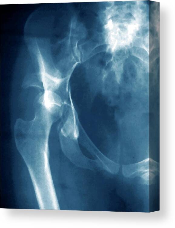 Injury Canvas Print featuring the photograph Hip Injury by Zephyr/science Photo Library
