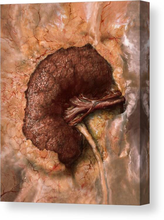 Abnormal Canvas Print featuring the photograph Kidney Disease Progression, 3 Of 3 by Anatomical Travelogue