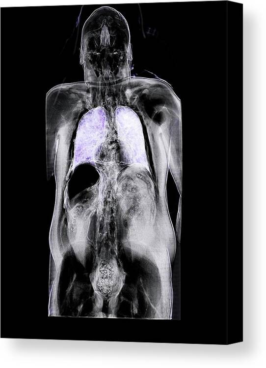 Pneumoperitoneum Canvas Print featuring the photograph Trapped Abdominal Gas by Anders Persson, Cmiv