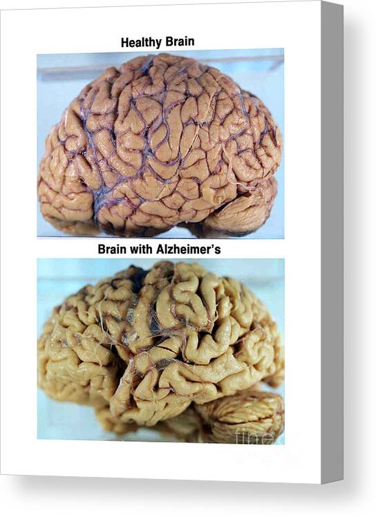 Science Canvas Print featuring the photograph Healthy And Alzheimer Brains, Gross by Science Source