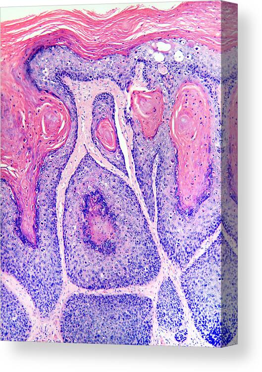 Squamous In Situ Canvas Print featuring the photograph Skin Cancer, Bowens Disease, Lm by Garry DeLong