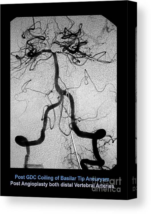 Cerebral Canvas Print featuring the photograph Cerebral Angiogram #1 by Medical Body Scans