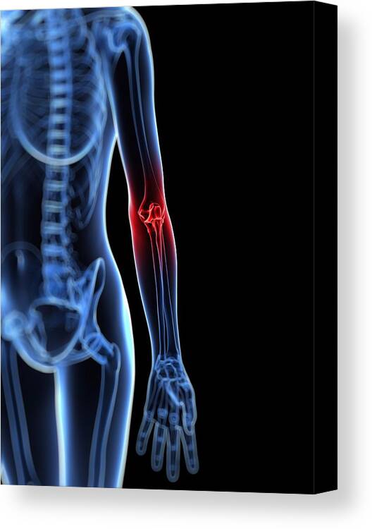 Vertical Canvas Print featuring the digital art Elbow Pain, Conceptual Artwork #3 by Sciepro
