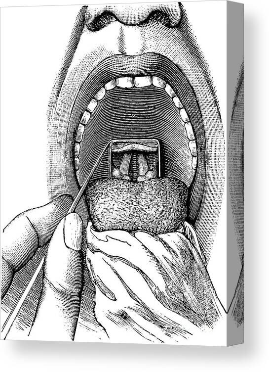 Engraving Canvas Print featuring the digital art Laryngoscopy Showing View by Morphart Creation