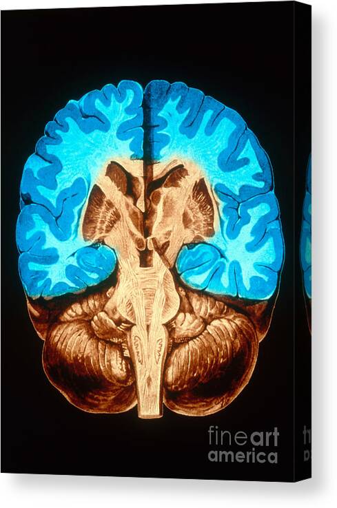 Brain Canvas Print featuring the photograph Brain, Coronal Section by Scott Camazine