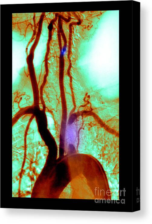 Abnormal Angiogram Canvas Print featuring the photograph Aortic Arch Angiogram #1 by Medical Body Scans