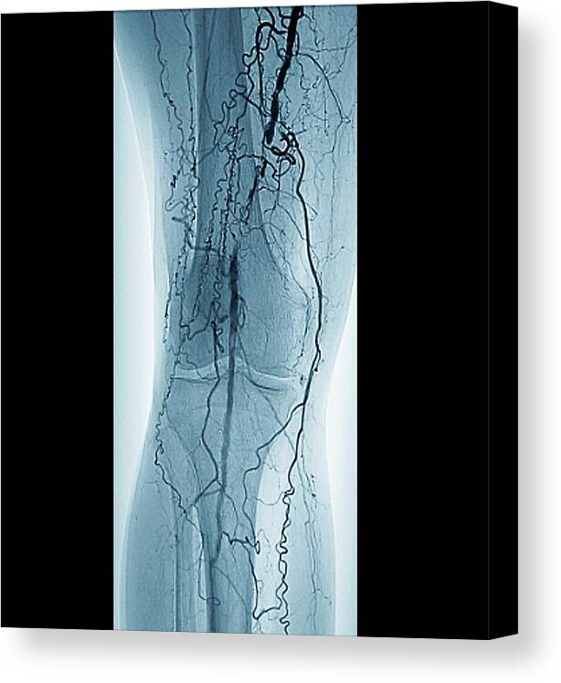 Black Background Canvas Print featuring the photograph Peripheral Vascular Disease In Diabetes by Zephyr/science Photo Library