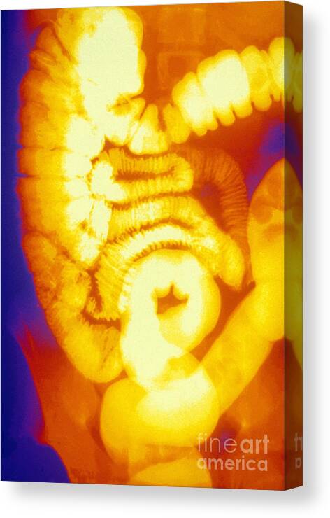 Medical Canvas Print featuring the photograph Large And Small Intestine, Barium X-ray #2 by Susan Leavines
