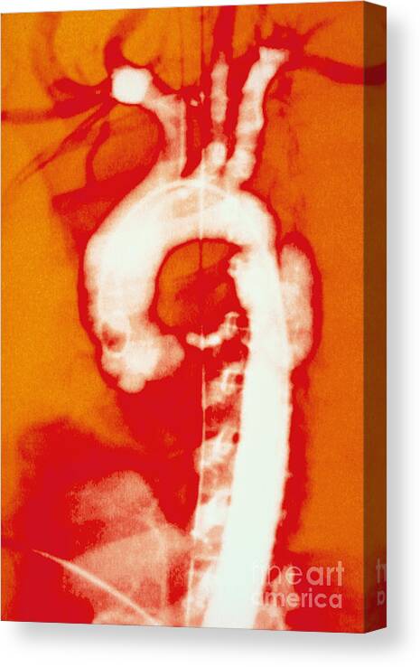Biology Canvas Print featuring the photograph Aortic Aneurysm by Lunagrafix