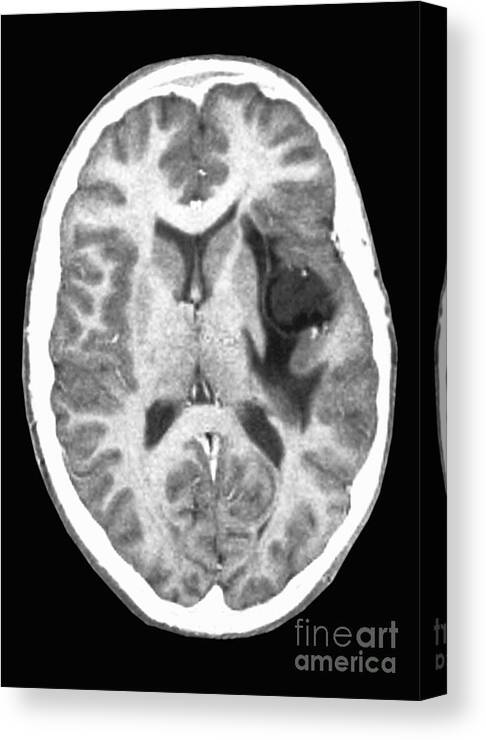 Radiology Canvas Print featuring the photograph Glioma Brain Tumor by Scott Camazine