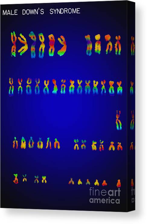 Down's Syndrome Canvas Print featuring the photograph Downs Syndrome Karyotype by Omikron