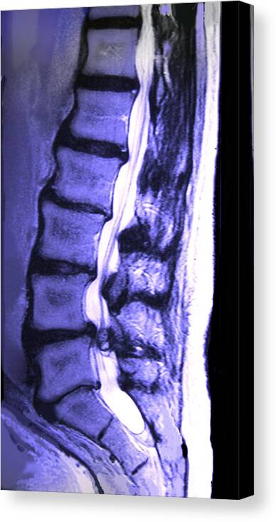 Aging Canvas Print featuring the photograph Arthritic Spine #3 by Chris Bjornberg