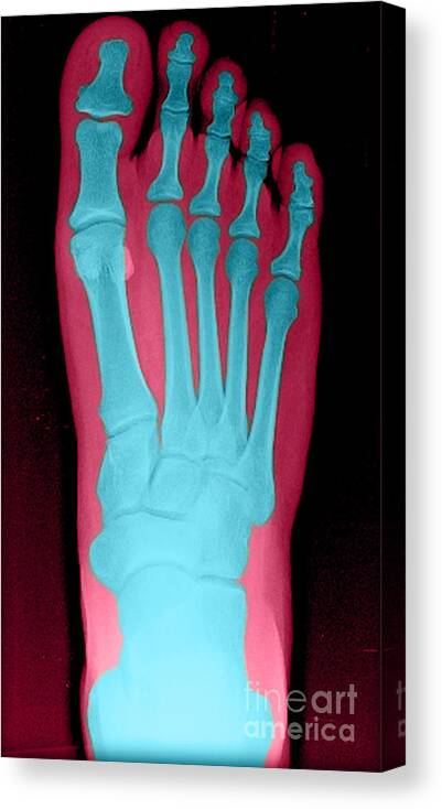 Bone Canvas Print featuring the photograph Human Foot by Medical Body Scans