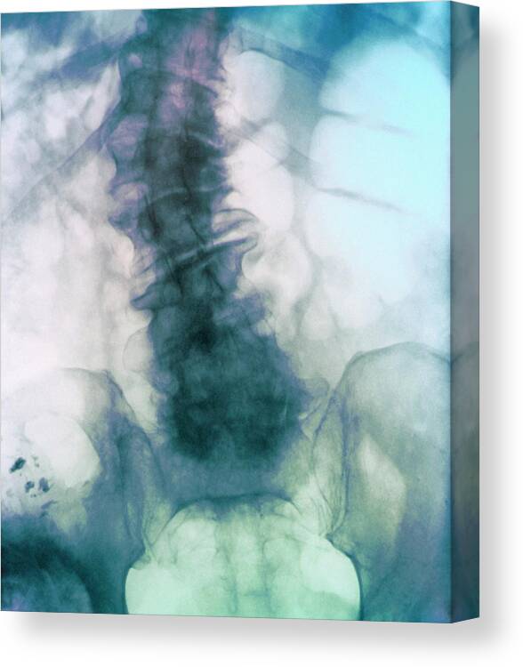 Scoliosis Canvas Print featuring the photograph Diseased Spine #1 by Zephyr/science Photo Library