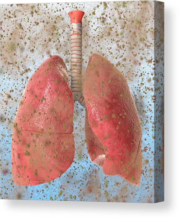 Abnormal Canvas Print featuring the photograph Allergen-related Asthma by Animated Healthcare Ltd/science Photo Library