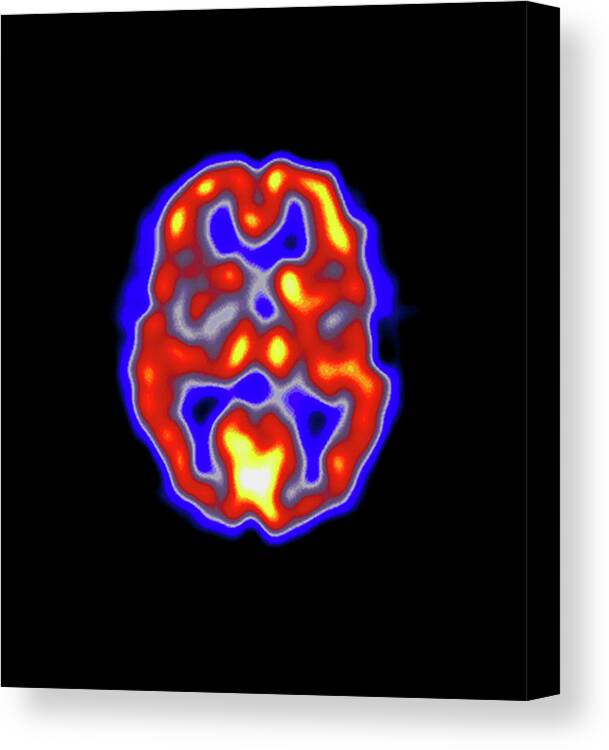 Pet Scan Canvas Print featuring the photograph Coloured Pet Scan Of The Brain Of A Stroke Patient by Dept. Of Nuclear Medicine, Charing Cross Hospital/science Photo Library