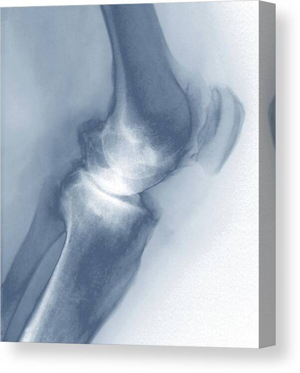 68 Canvas Print featuring the photograph Osteoarthritis Of The Knee #15 by Zephyr/science Photo Library