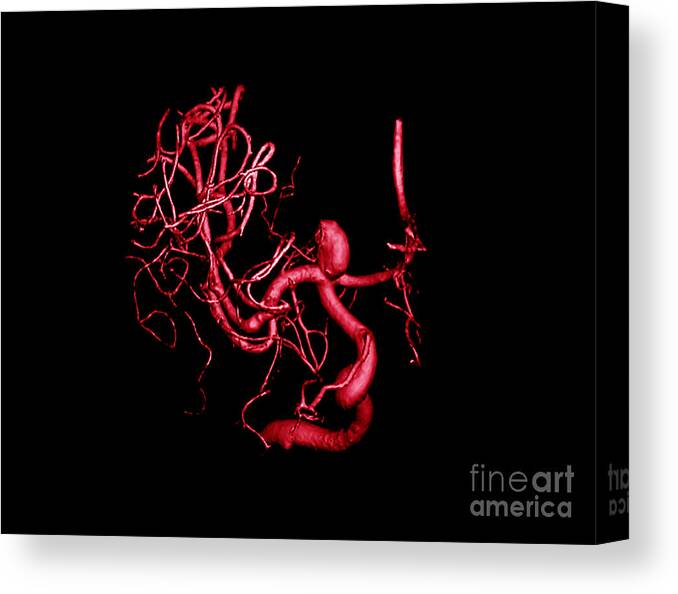 Cerebral Angiogram Canvas Print featuring the photograph Cerebral Aneurysm, 3d Scan by Living Art Enterprises